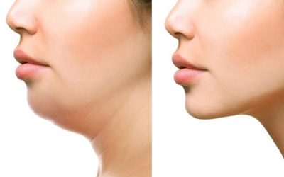 Reclaim Your Confidence with Kybella